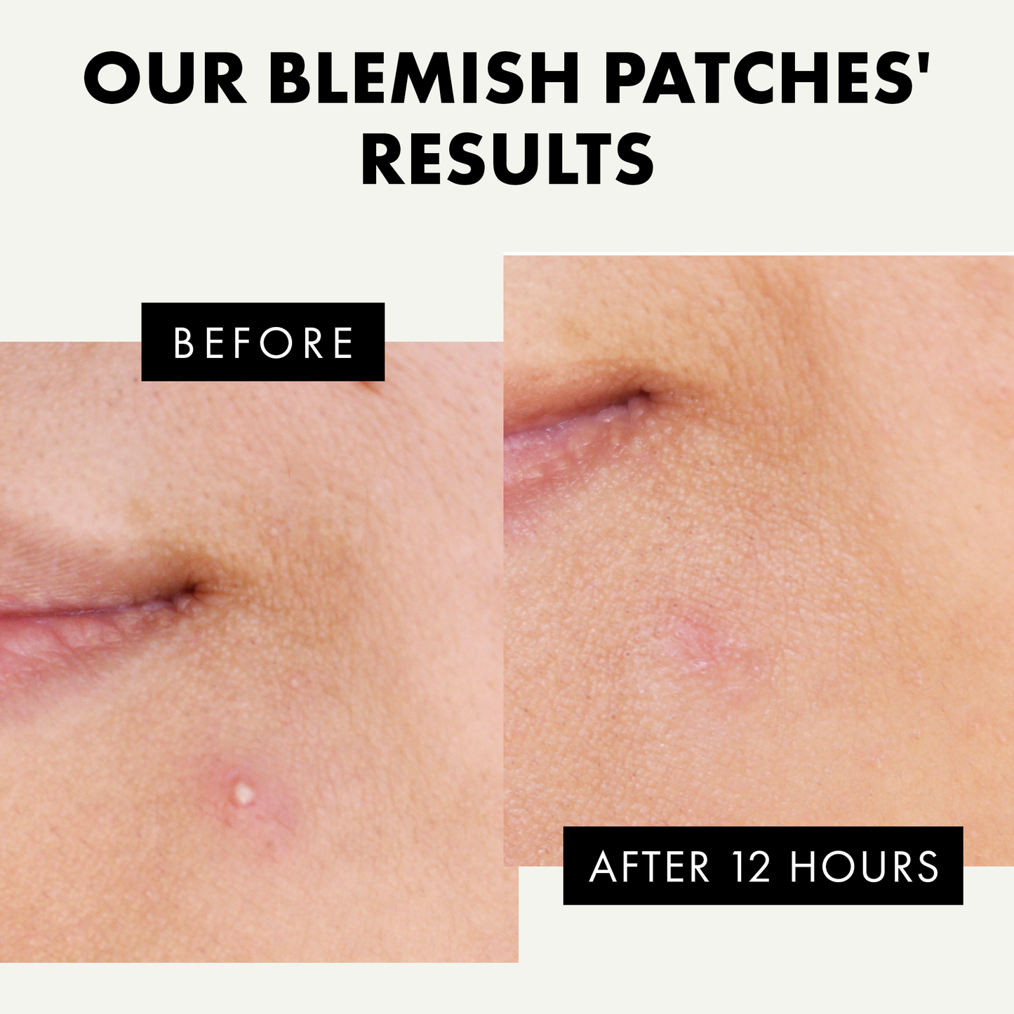 𝗢𝗿𝗴𝗮𝗻𝗶𝗰 Acne Patches